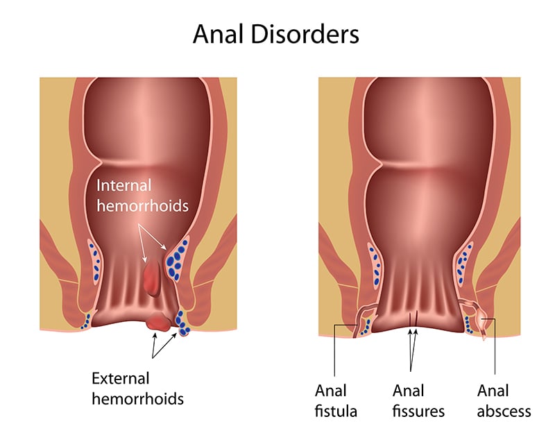 Fistula in Ano