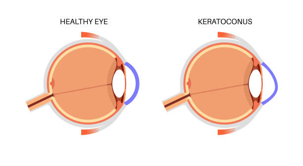 KERATOCONUS