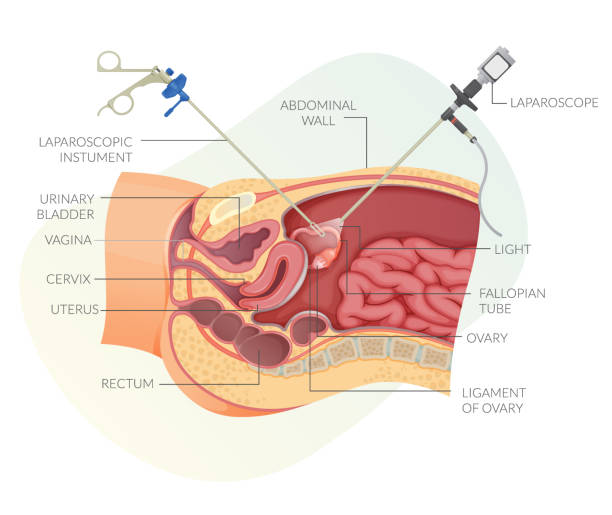 LAPAROSCOPY
