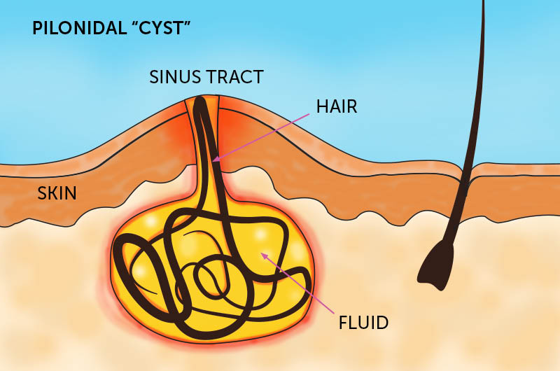 Perianal Sinus 