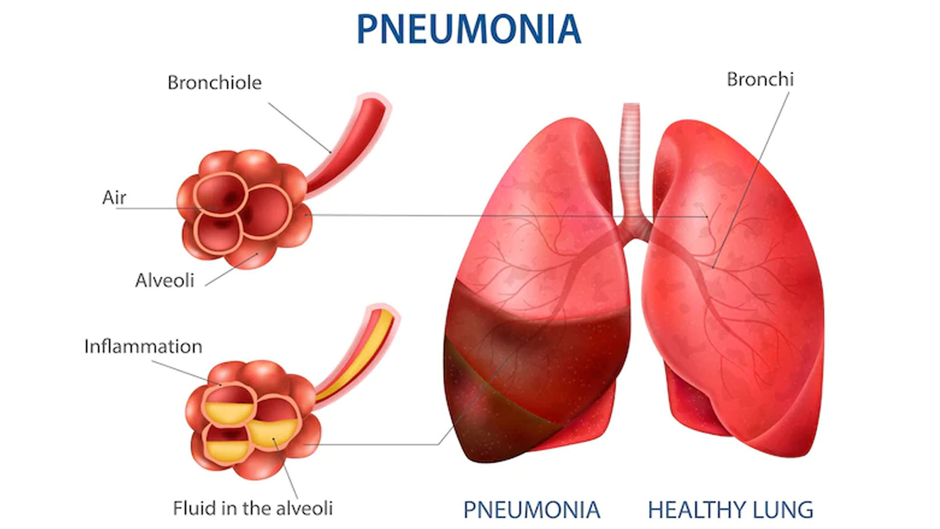 Pneumonia