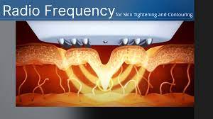 RADIOFREQUENCY