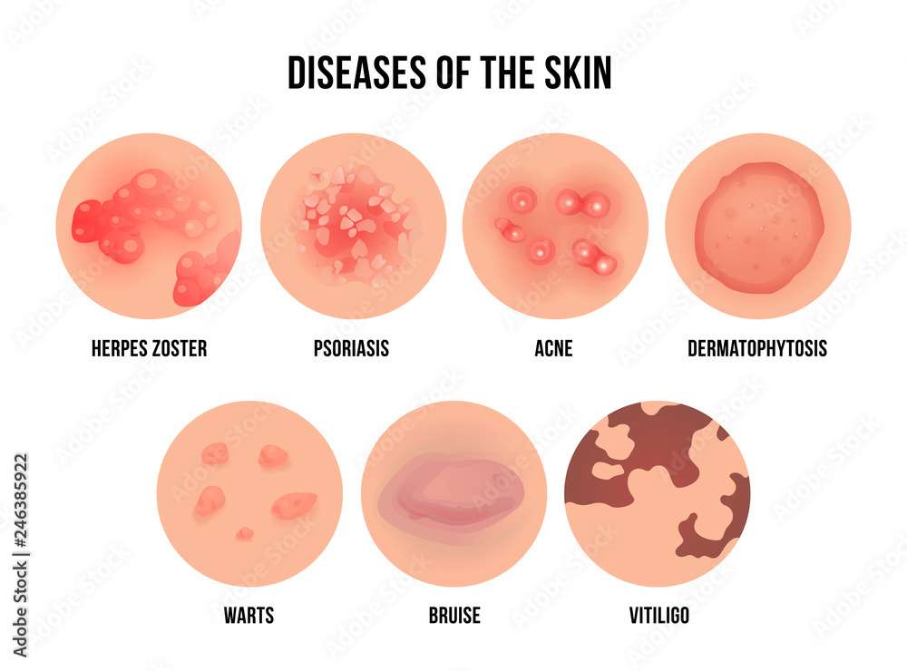 Skin Diseases