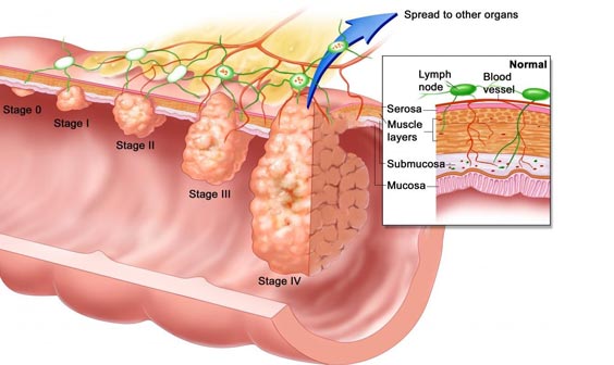 Perianal worts