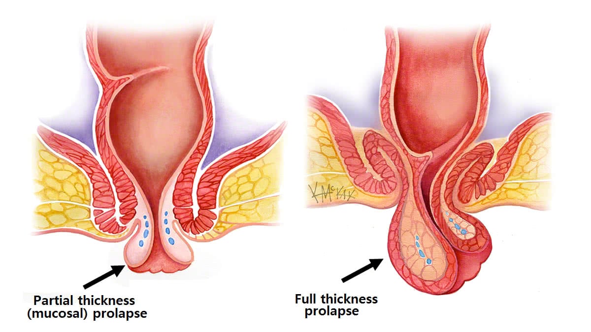 Rectal Prolapse