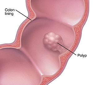 Rectal Polyps
