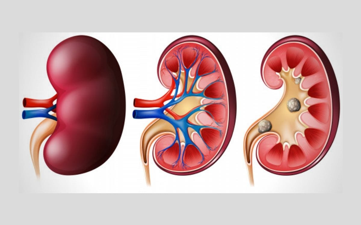 Renal Calculli