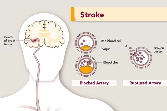 Stroke