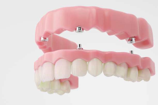 Full Mouth Rehabilitation At Smiling Teeth