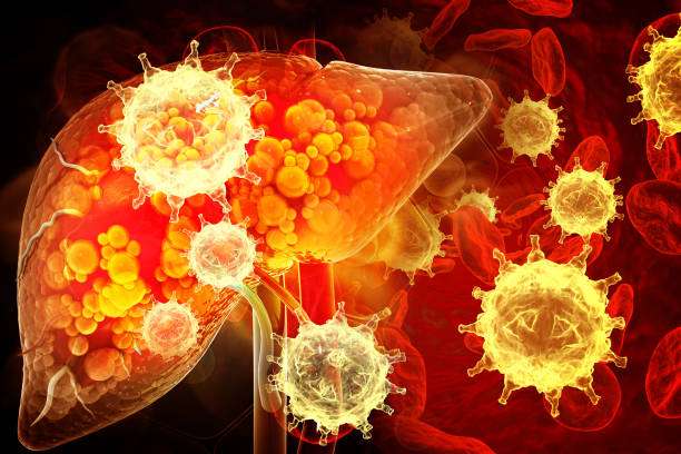 Liver Cancer