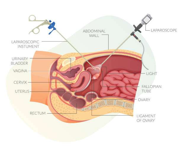 Laparoscopic Surgery